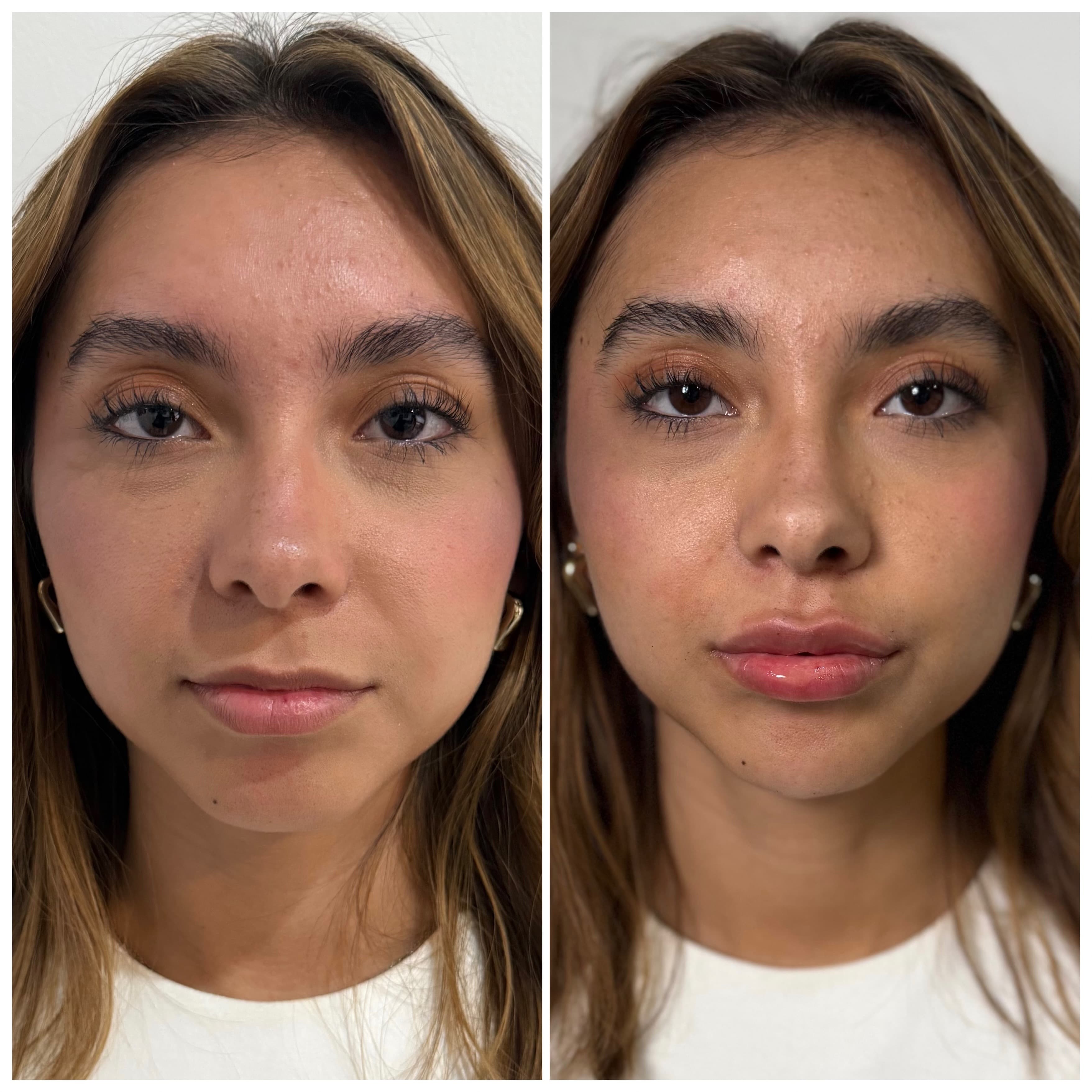 Aumento de Labios antes y después