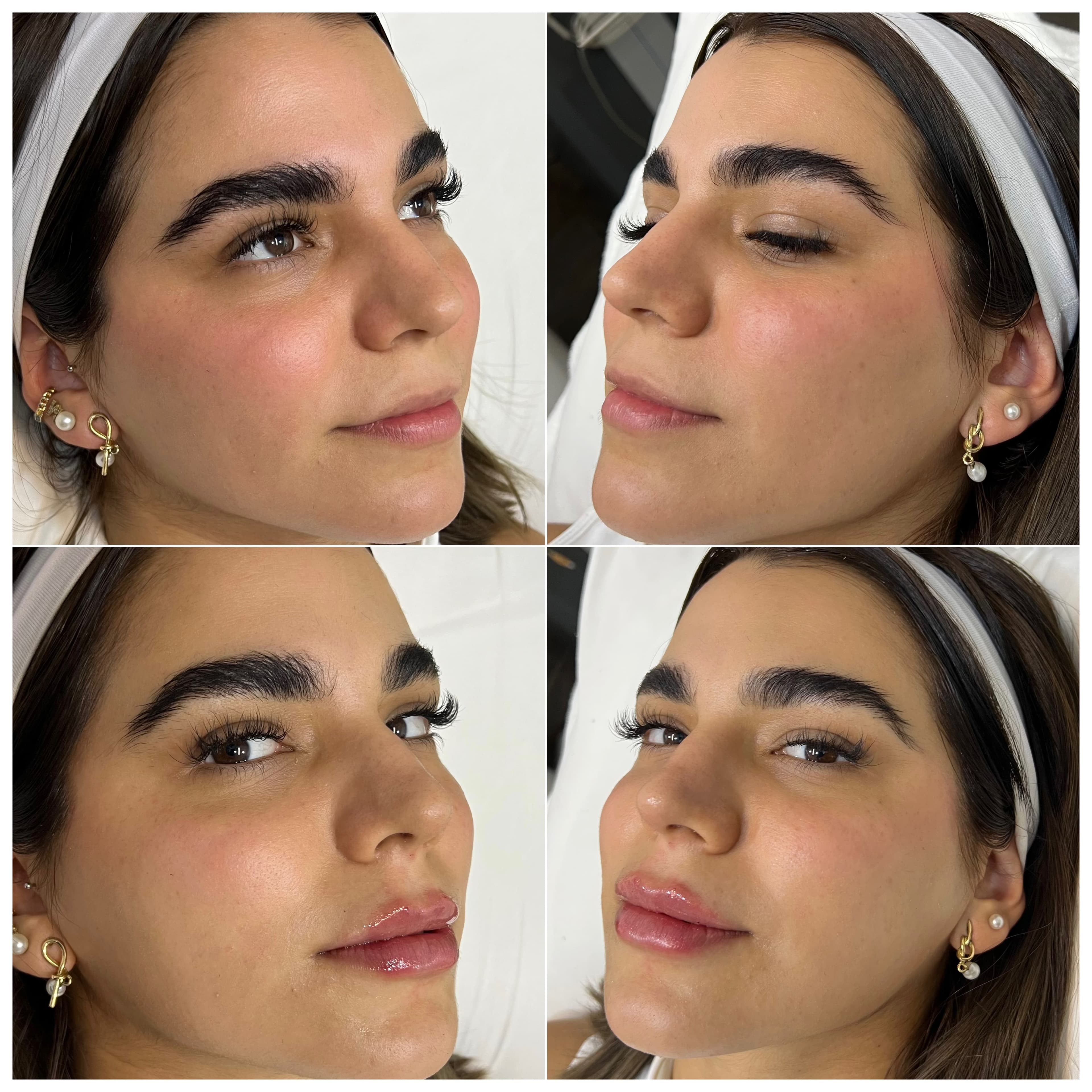 Aumento de Labios antes y después