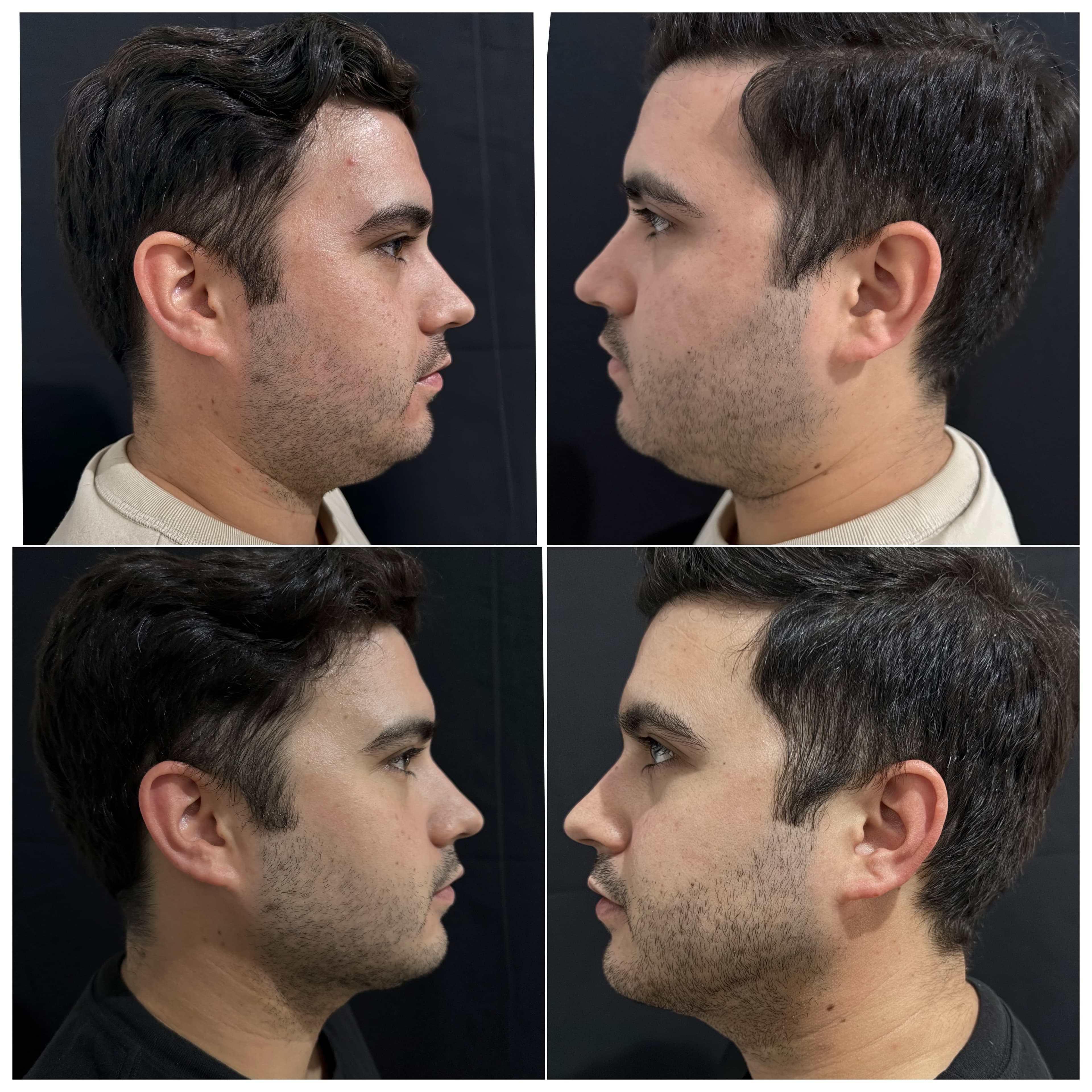 Lipopapada antes y después