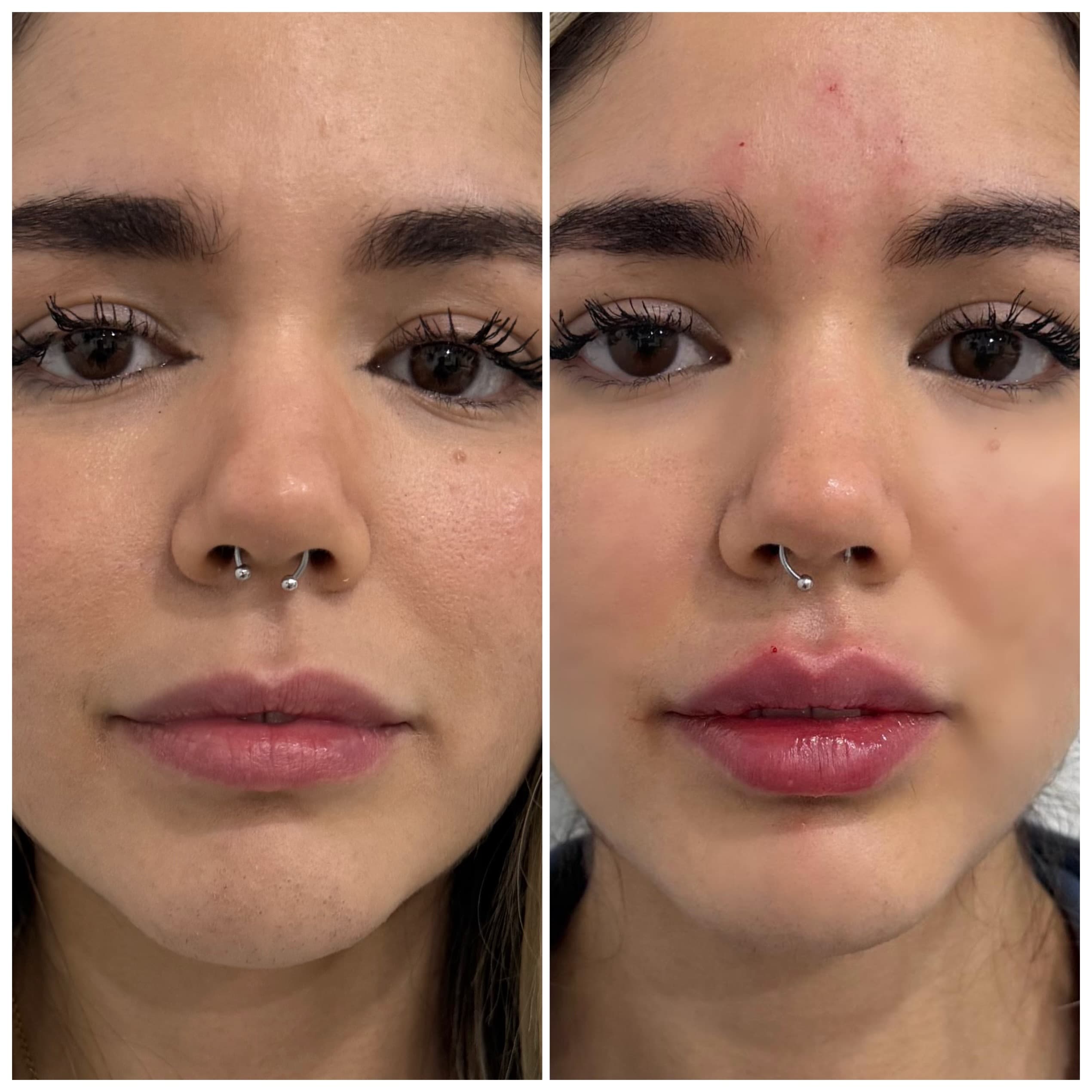 Resultado de Armonización Facial