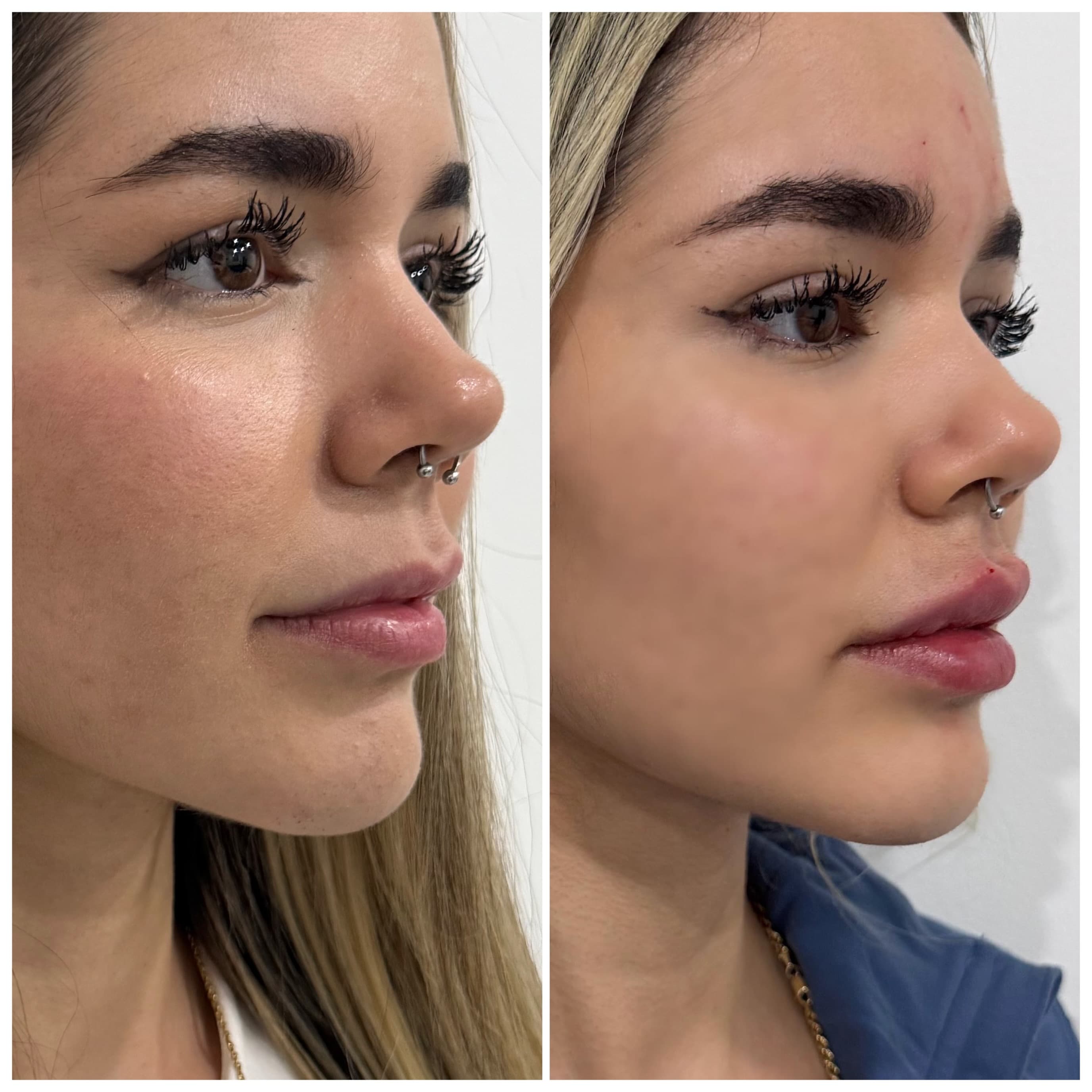 Resultado de Armonización Facial